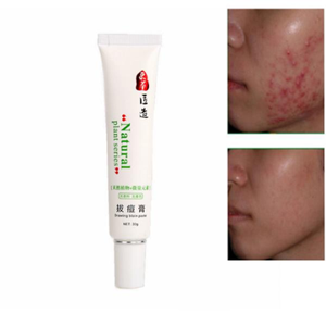 Anti Acne Cream